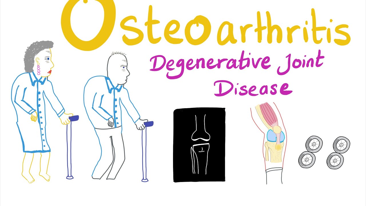 Osteoarthritis (OA) - Definition, Causes (Etiology) &  Epidemiology - Part 2 - Rheumatology
