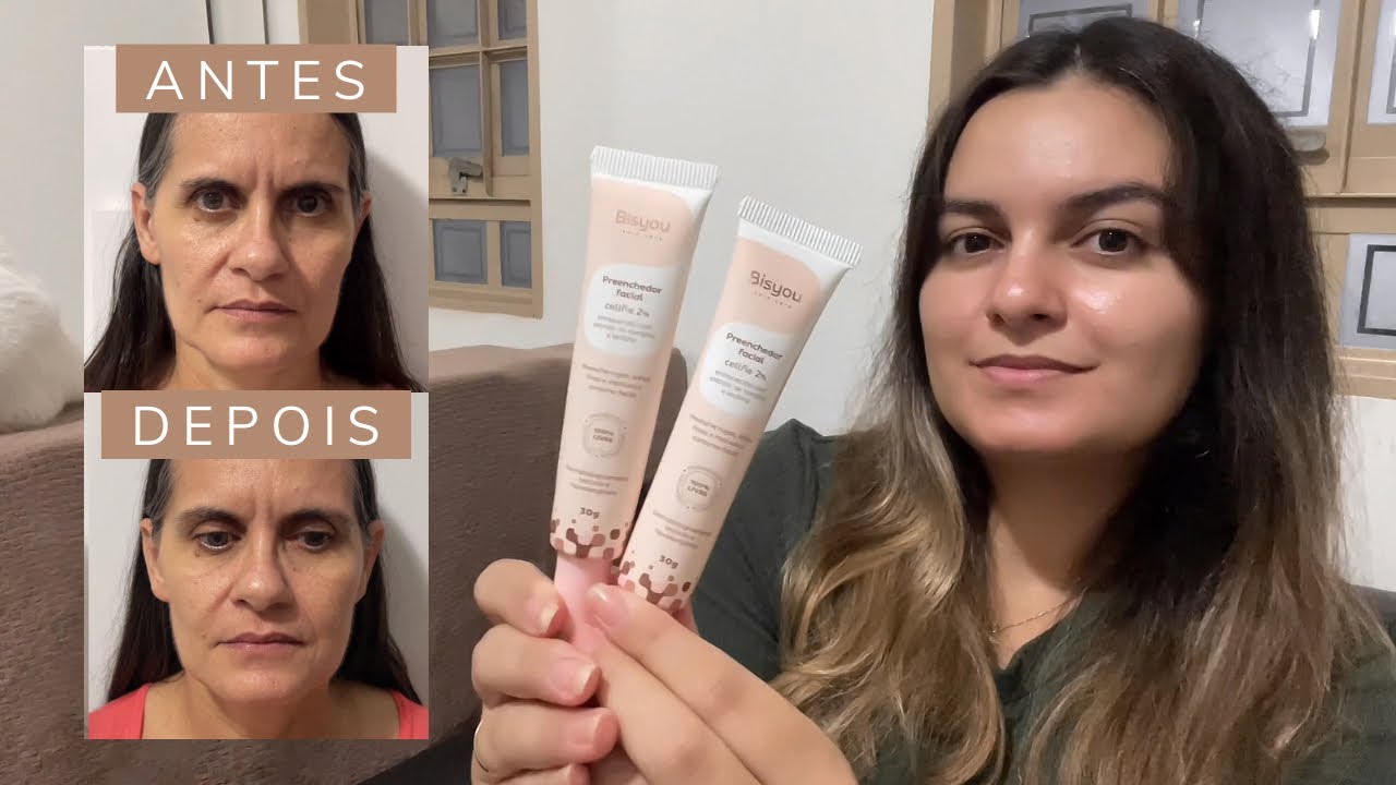 Preenchedor bisyou antes e depois | Preenchedor bisyou funciona em rugas e olheiras?