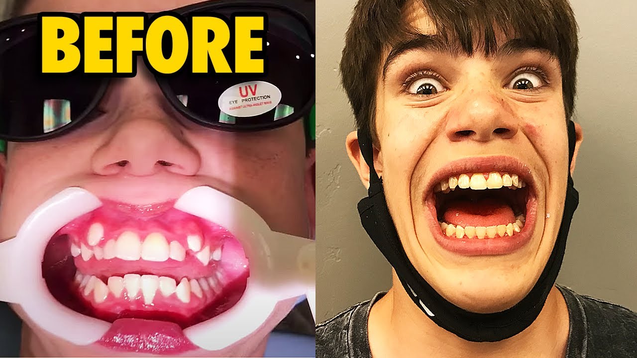 Getting My Braces Off... YES it HURT!