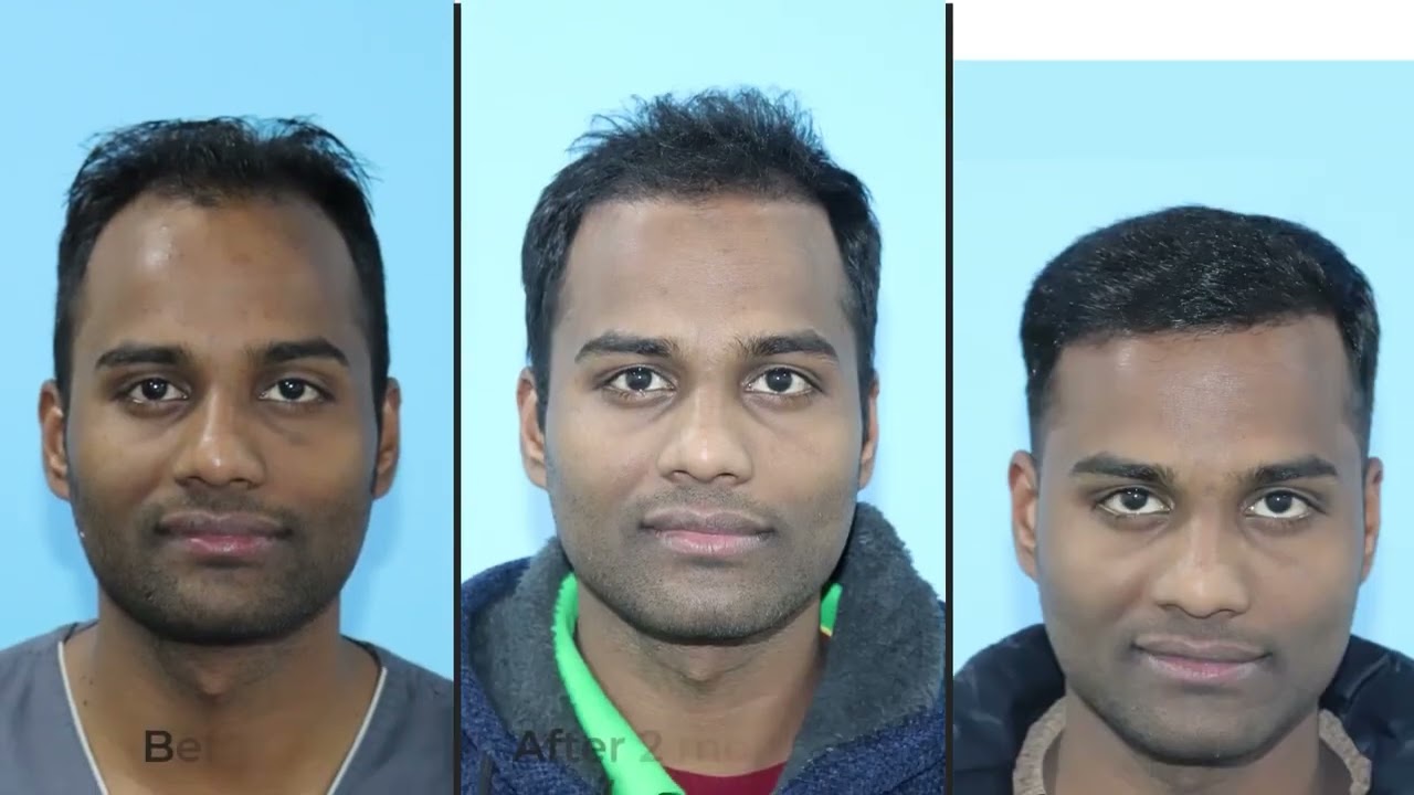 Hair Transplant Journey of RaR with Direct Hair Transplant at Folliderm, Nepal