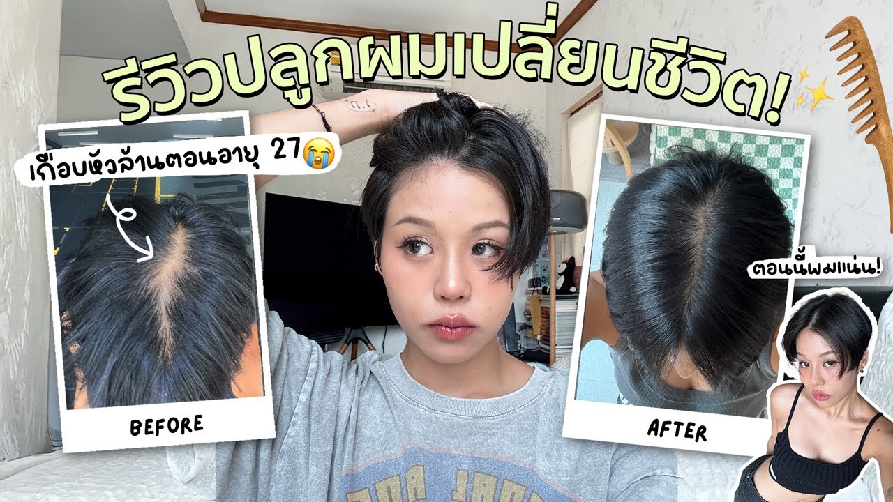 เกือบหัวล้านตอนอายุ 27😱 รีวิวปลูกผมเปลี่ยนชีวิตแบบเจาะลึก!