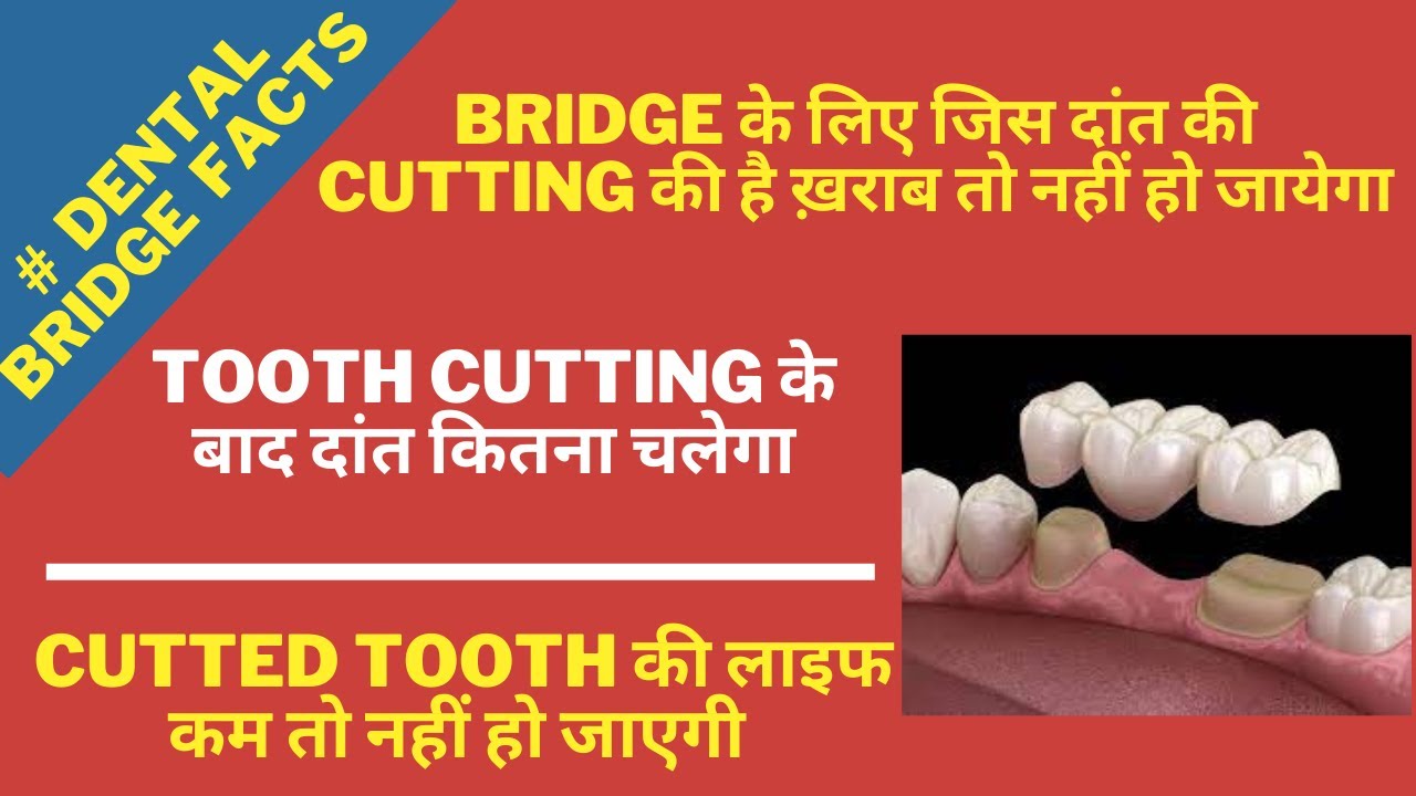 Dental Bridge facts-TOOTH CUTTING के बाद दांत कितना चलेगा