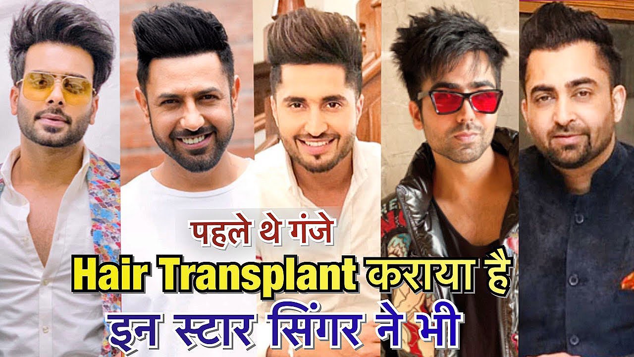 Case Study: Top Punjabi Singer Hair Transplant Surgery | Before After Hair transplant Result
