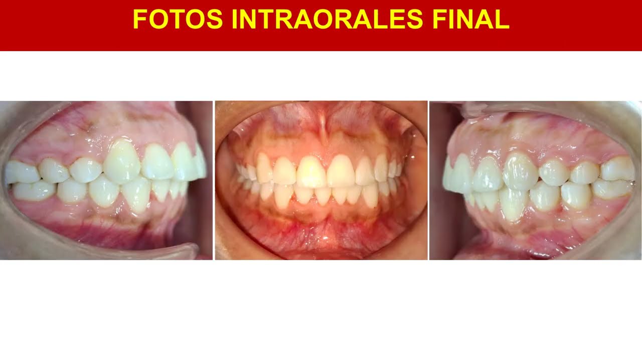 #ortodoncia  Caso clínico: Retratamiento de Clase II con apiñamiento y fusión dentaria