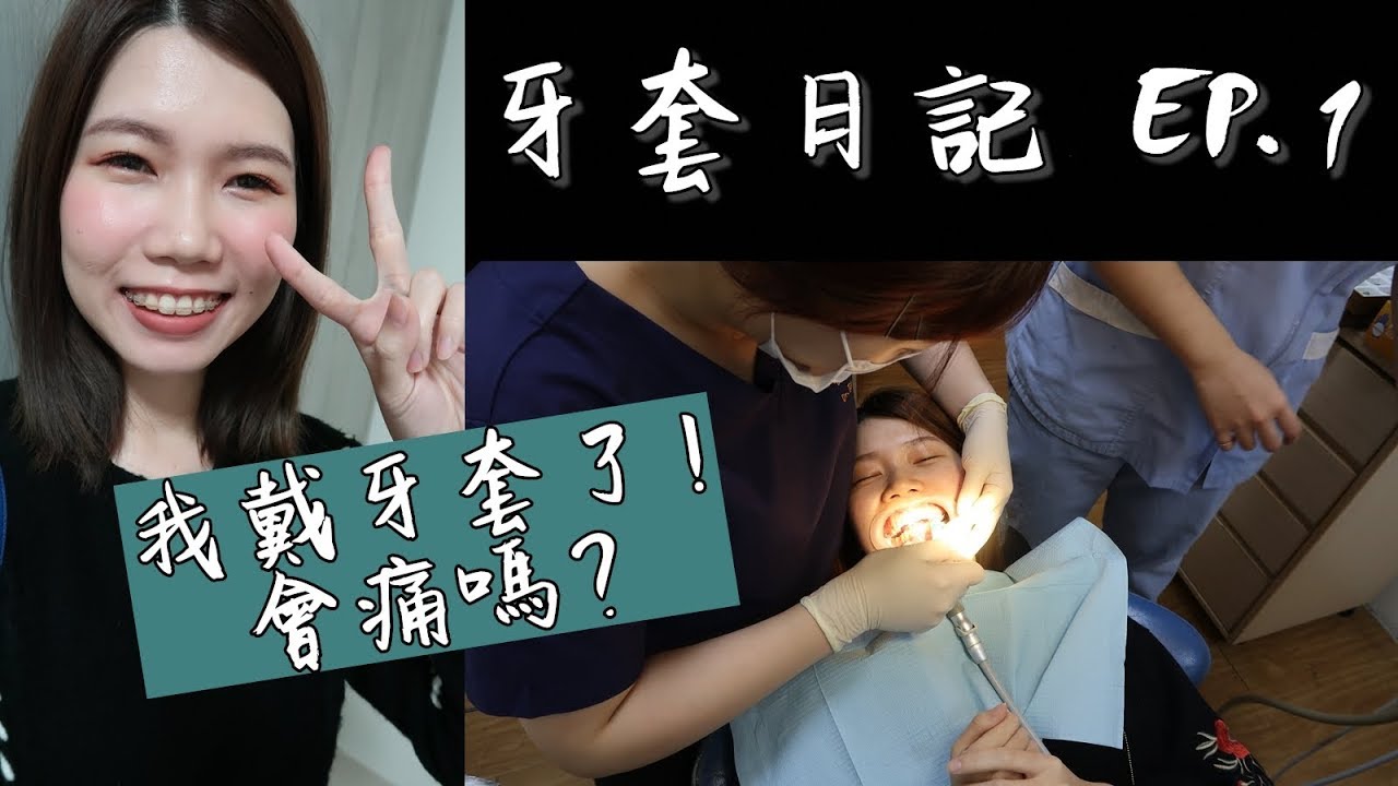 牙套日記EP.1 | 形象崩壞的戴牙套過程紀錄 | 戴牙套會痛嗎？最痛苦的是？