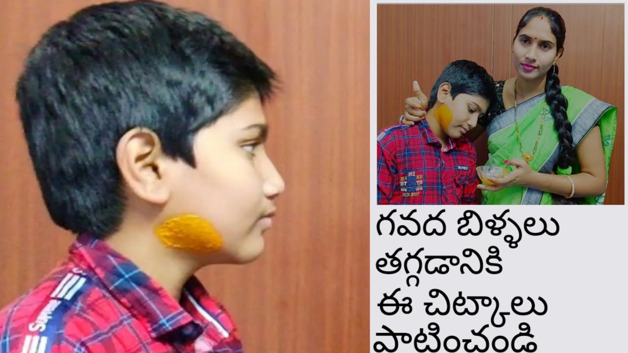 గవద బిళ్ళలు తగ్గడానికి ఈ చిన్ని చిట్కాలు పాటించండి|Home remidy for mumps|టన్సిల్స్ తగ్గించే చిట్కాలు