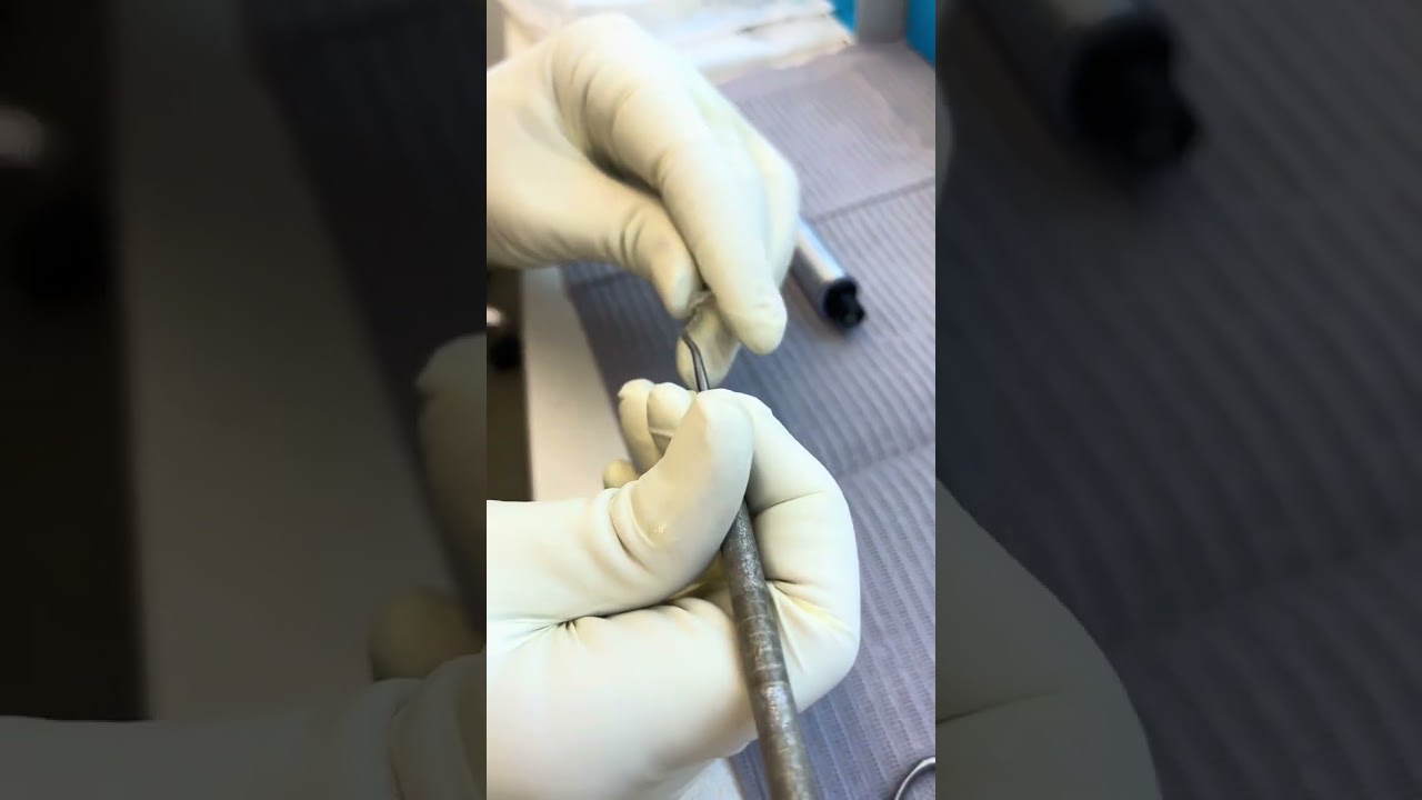 Qu&eacute; son los ataches dentales en Ortodoncia Invisible
