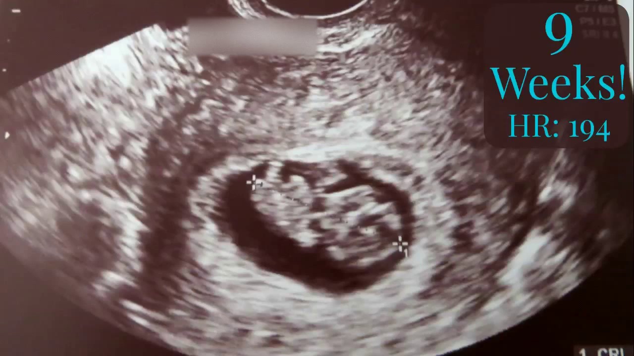 IVF Pregnancy!