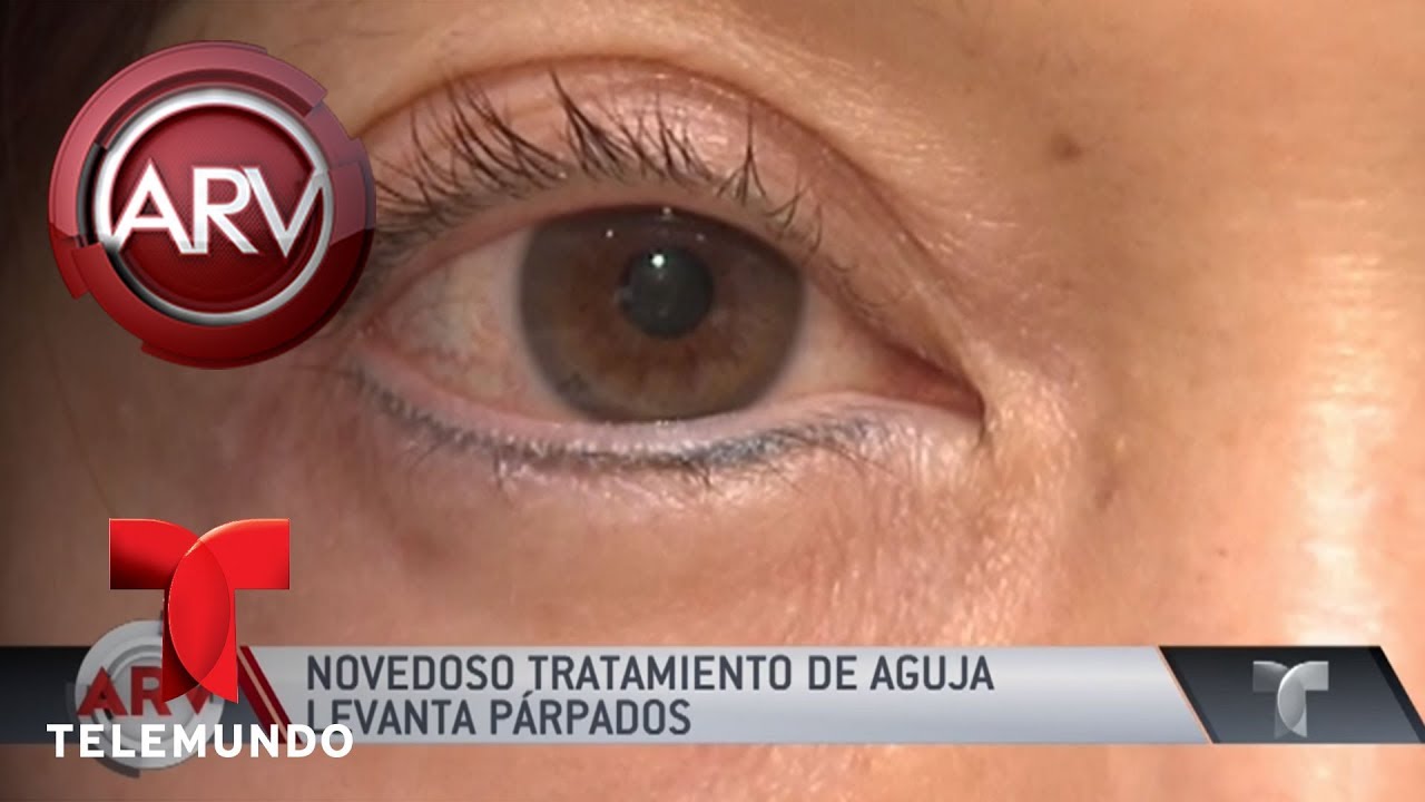 Llegó un novedoso tratamiento para los párpados caídos | Al Rojo Vivo | Telemundo