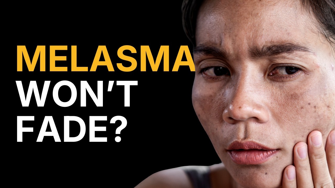 How to Treat Melasma and Pigmentation