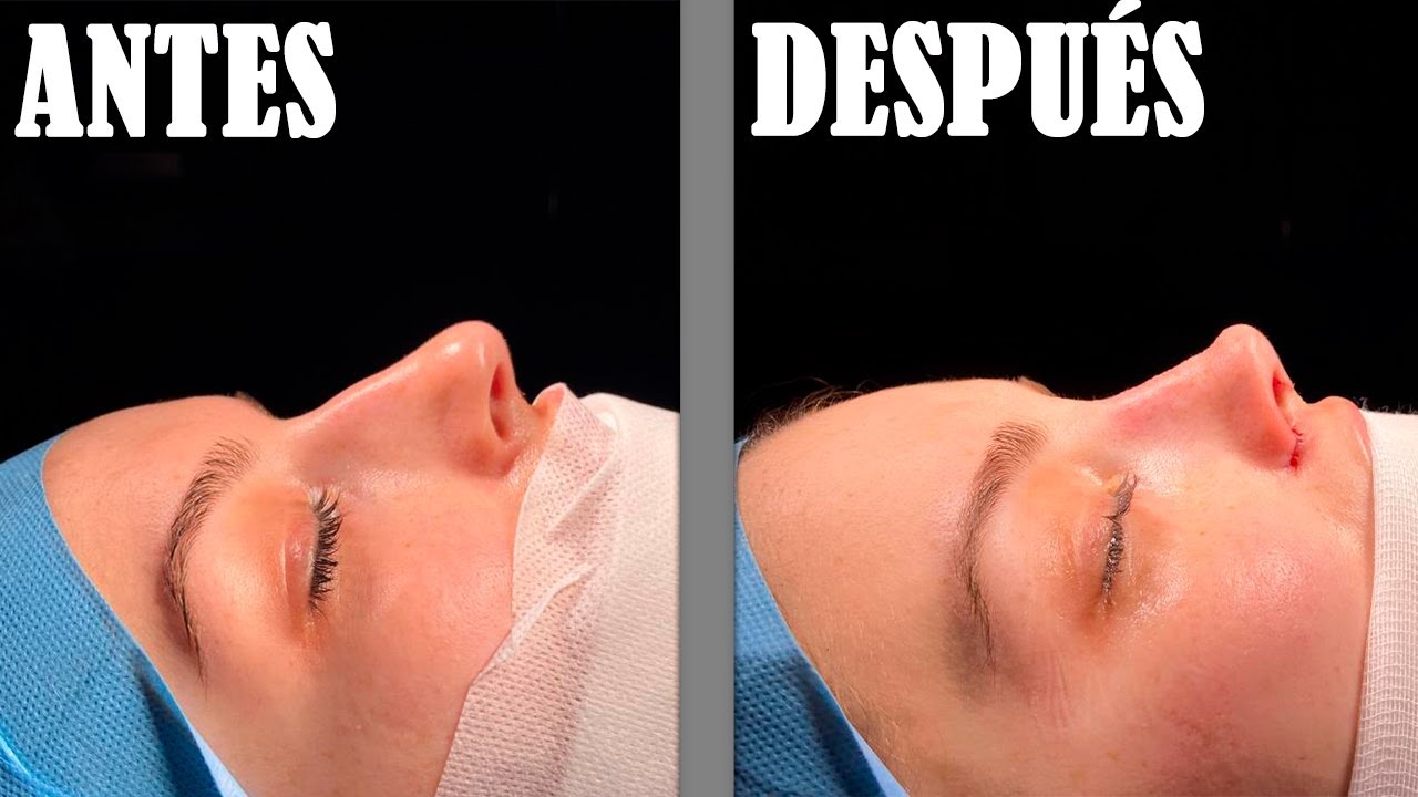 RESULTADO RINOPLASTIA Y VIDEO EN QUIRÓFANO - rhinoplasty results