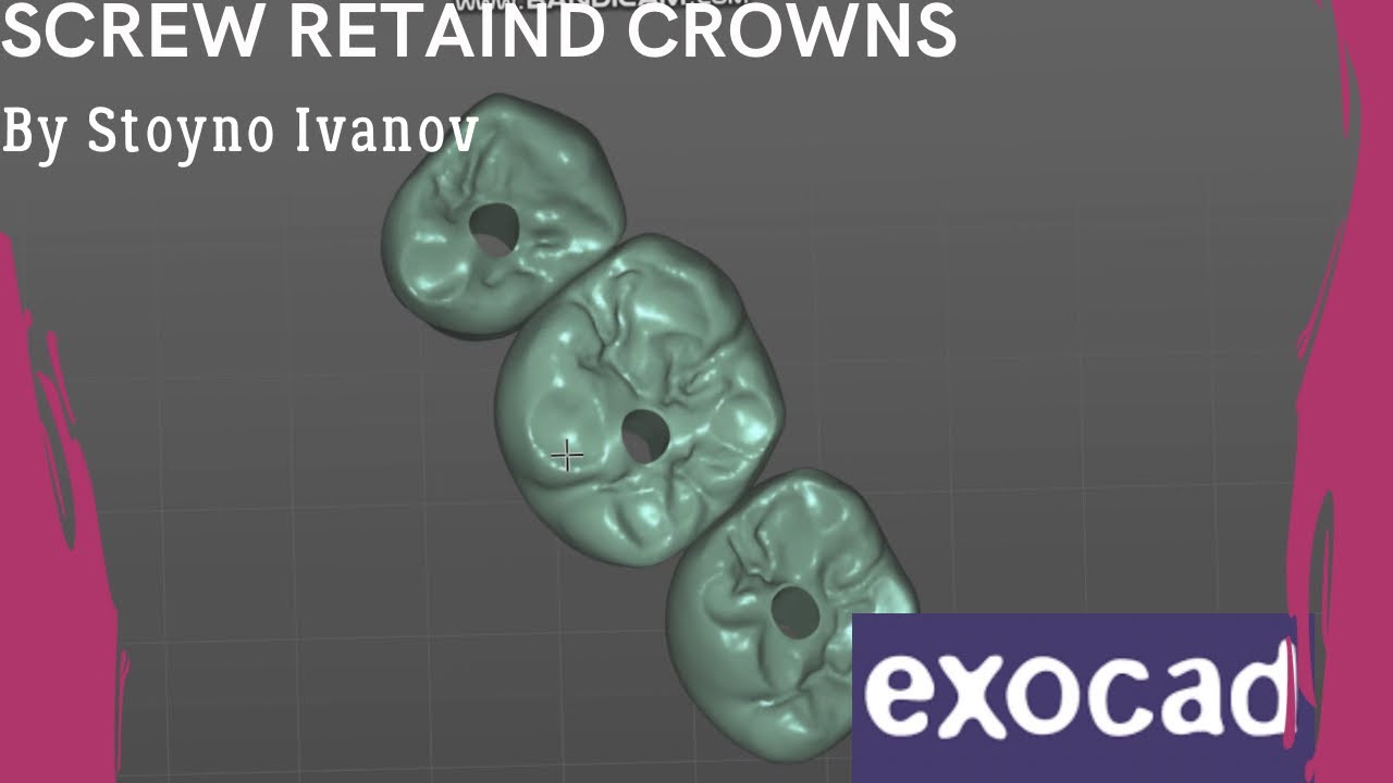 How to Create Screw Retaind Crowns- FAST and EASY in EXOCAD