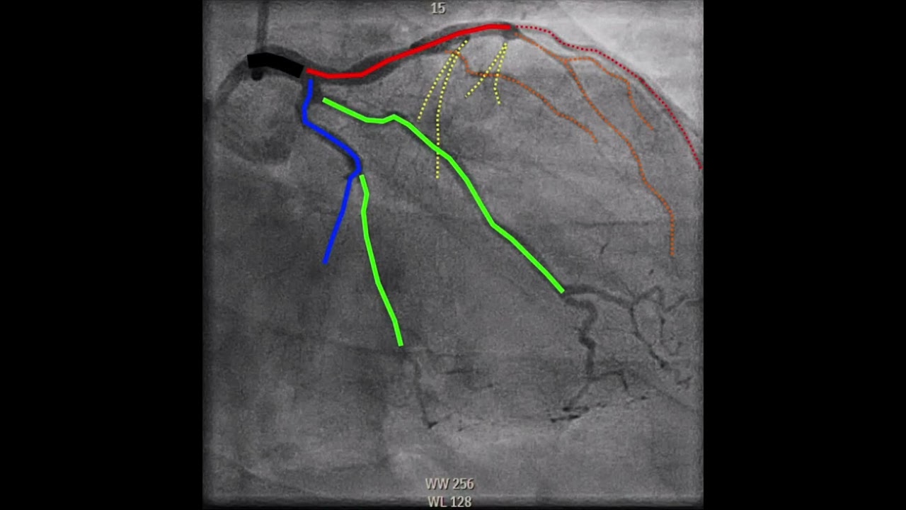 Coronary Vasospasm