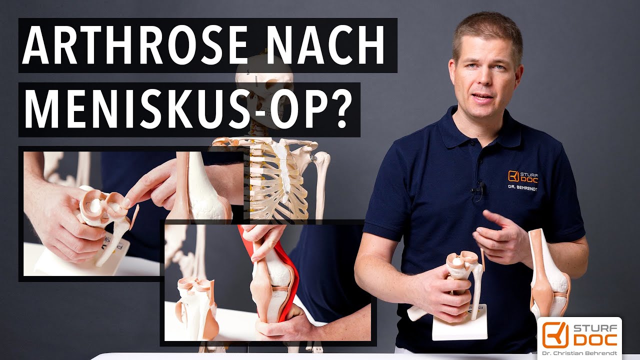 Meniskusoperation  - Führt sie zu einer Arthrose im Knie?