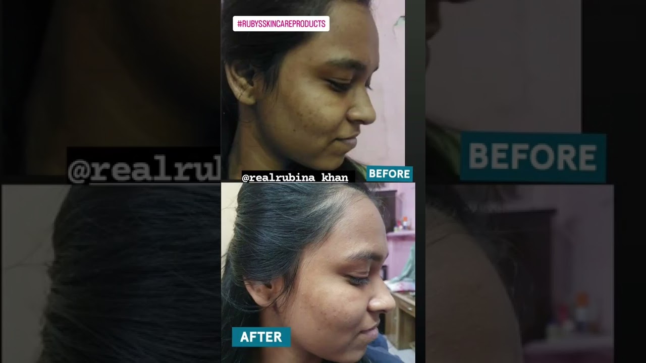 before and after Ruby's skin care products results guarantee suitable for all skin types