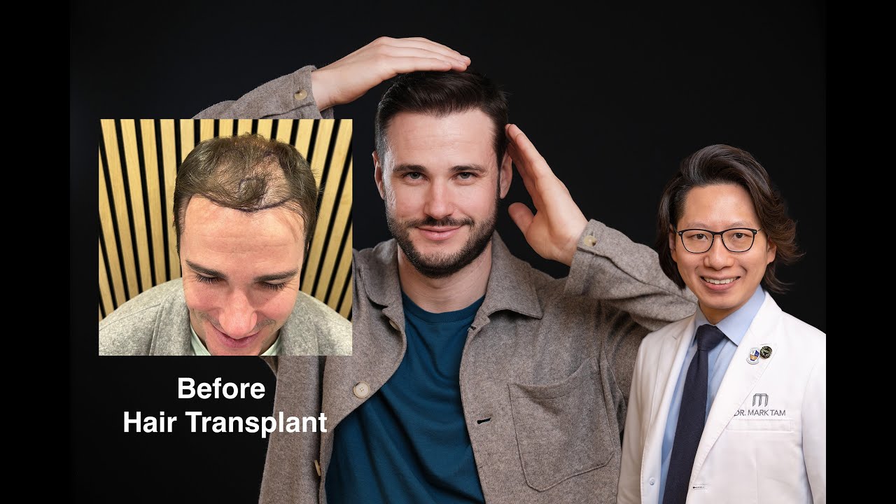 FUE Hair Transplant For Frontal Hairloss With Native Hair, Dr Mark Tam of Harley Street, London UK