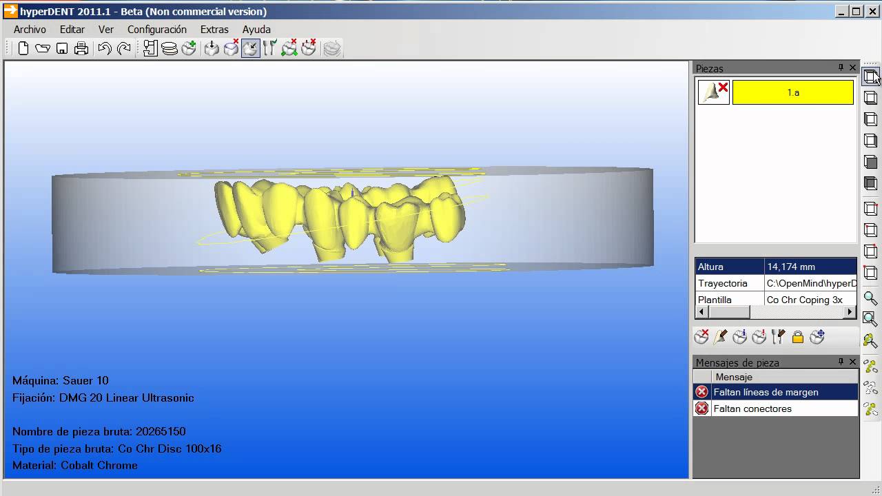 Fresado de un puente sobre implantes con hyperDENT