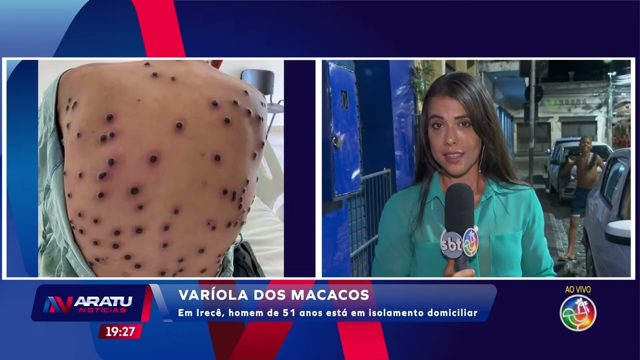 Varíola dos macacos | ARATU NOTÍCIAS | TV ARATU