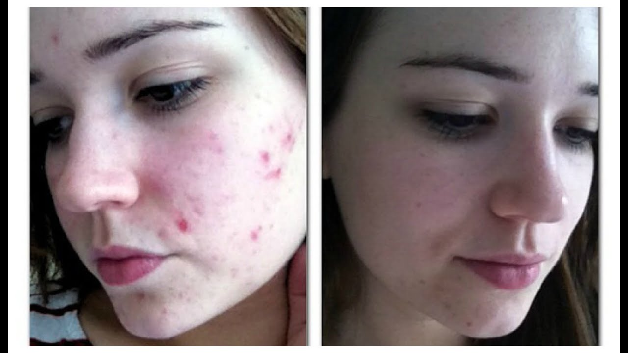 Skin Care Routine Before and After