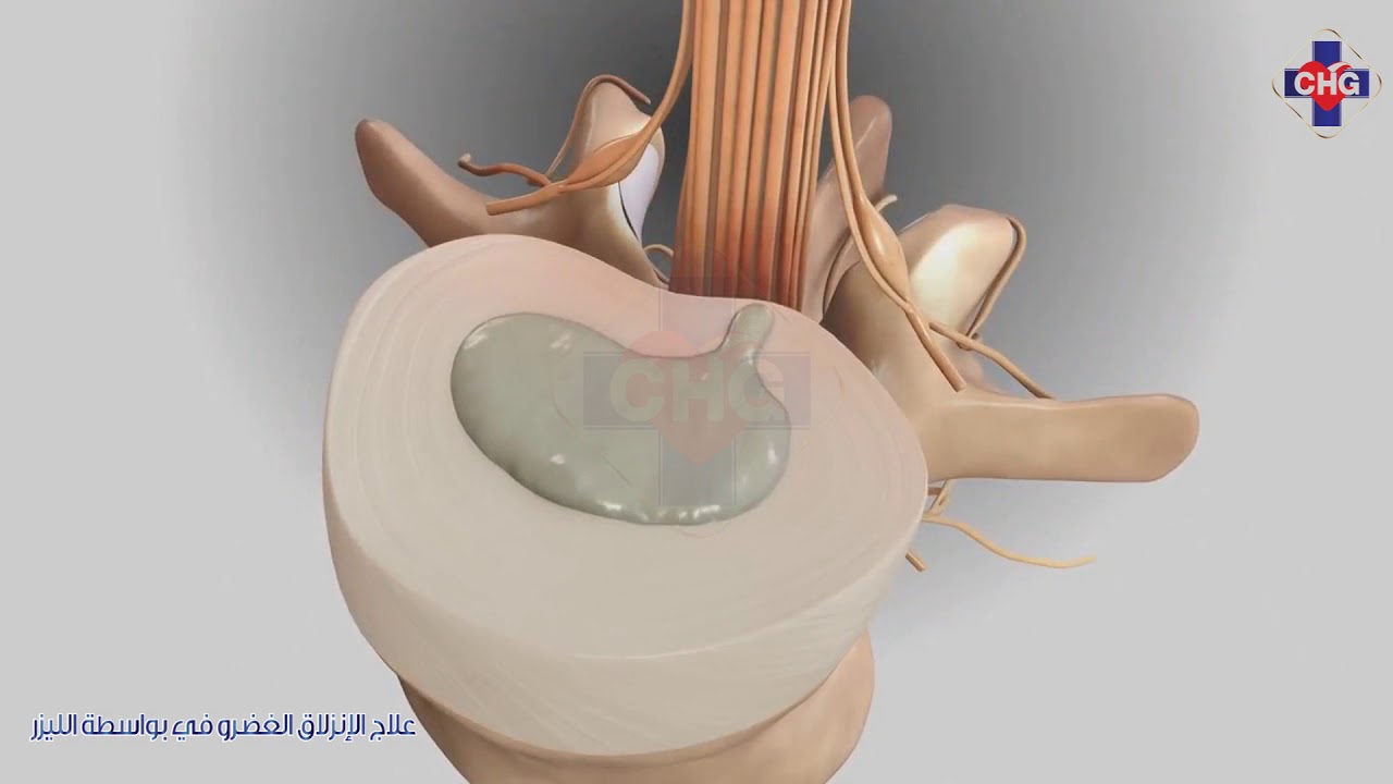 علاج الإنزلاق الغضروفي بواسطة الليزر في مستشفى جولارات 3 الدولي  تايلاند
