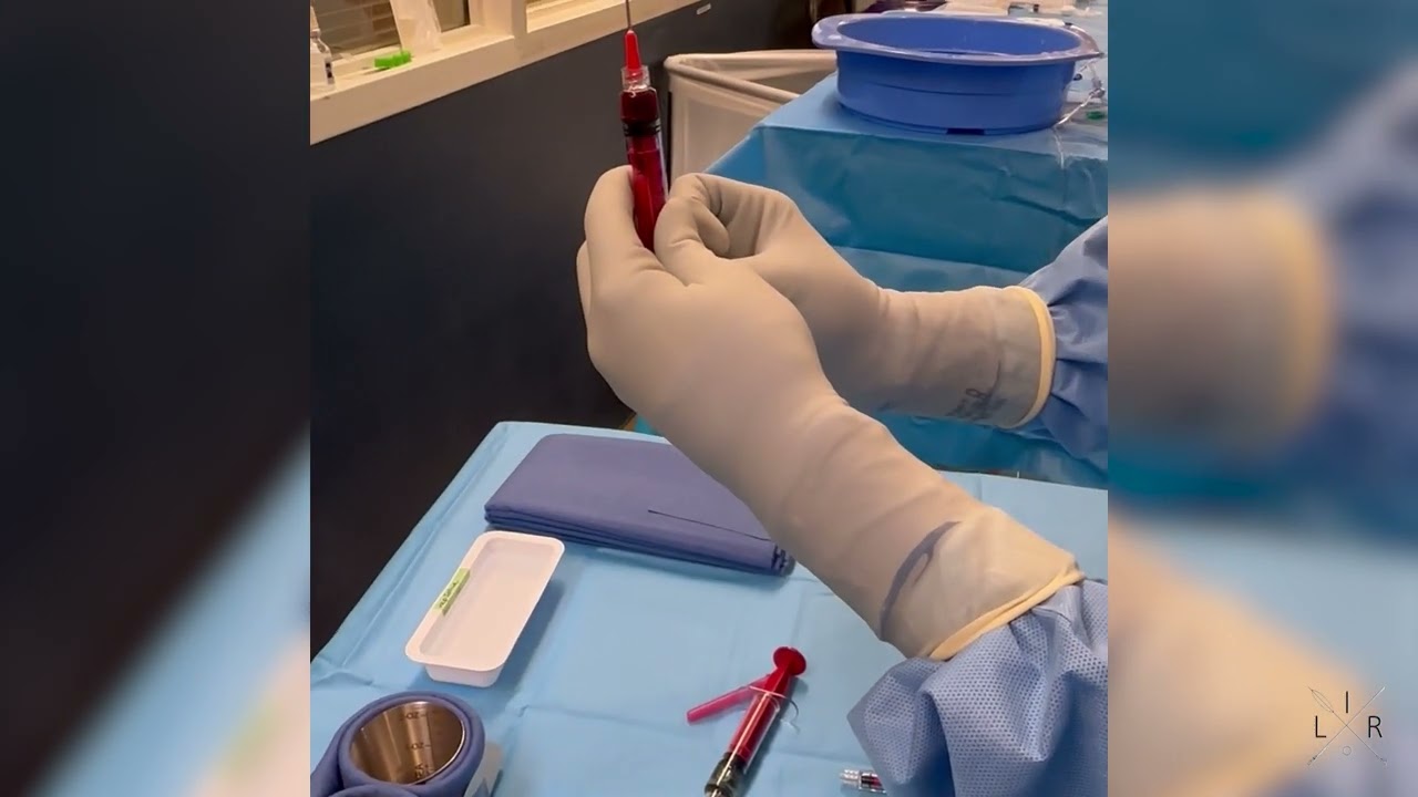 Mixing Lipiodol and Doxorubicin for cTACE