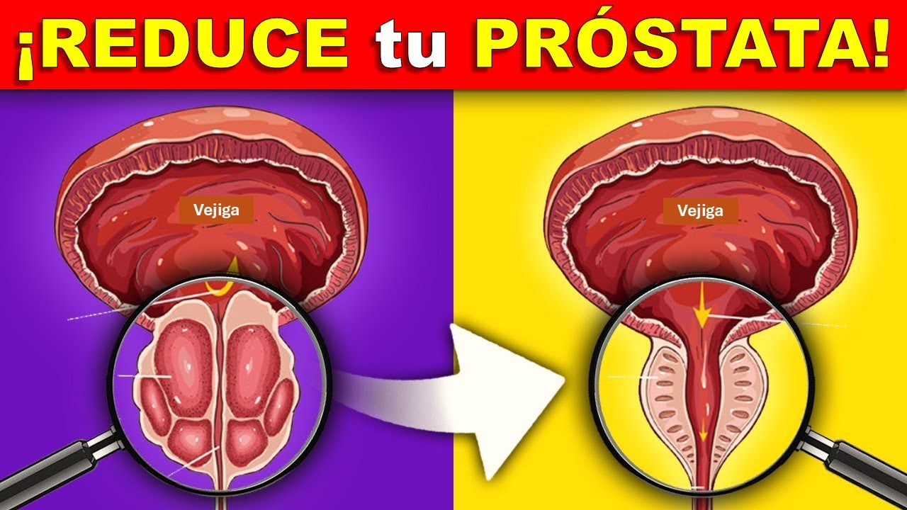 🔴 ¡SÚPER ALIMENTOS para REDUCIR la PRÓSTATA!