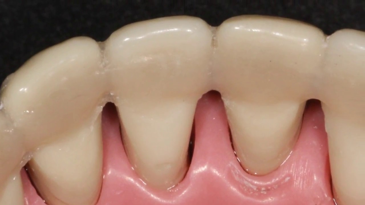 FÉRULA PERIODONTAL