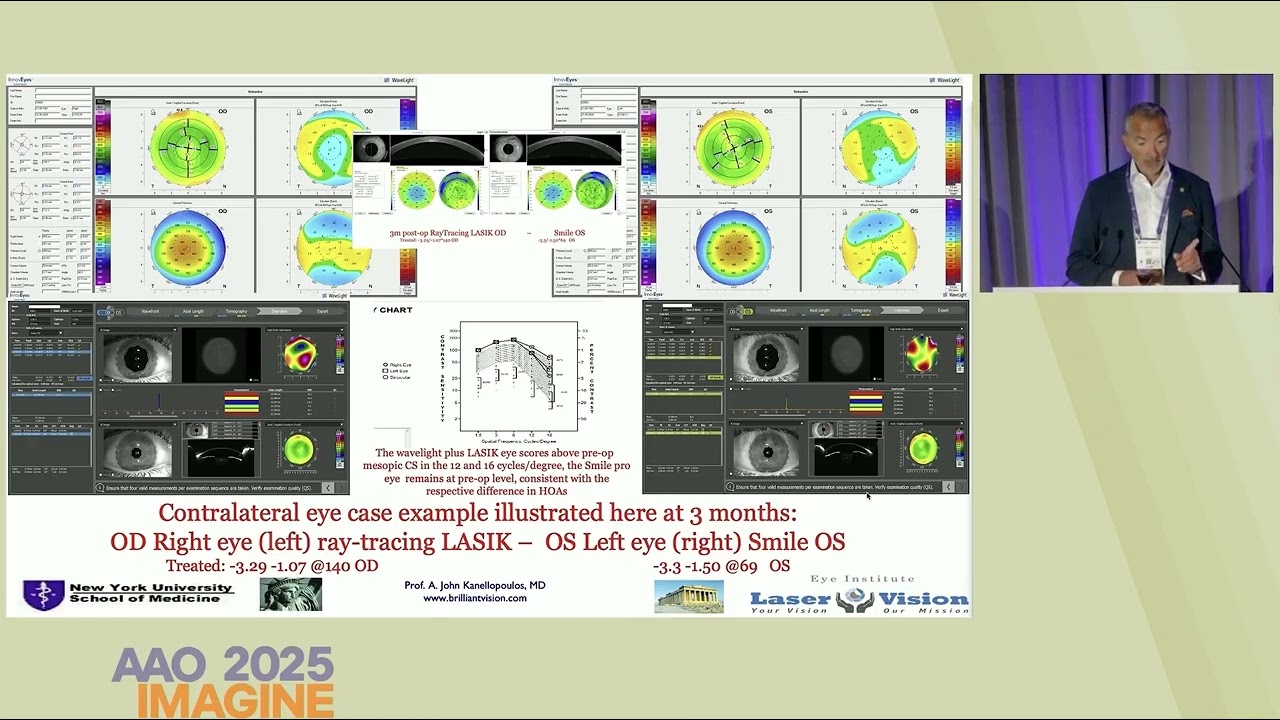 AAO 2025 | Ray-tracing optimized LASIK vs. SMILE PRO