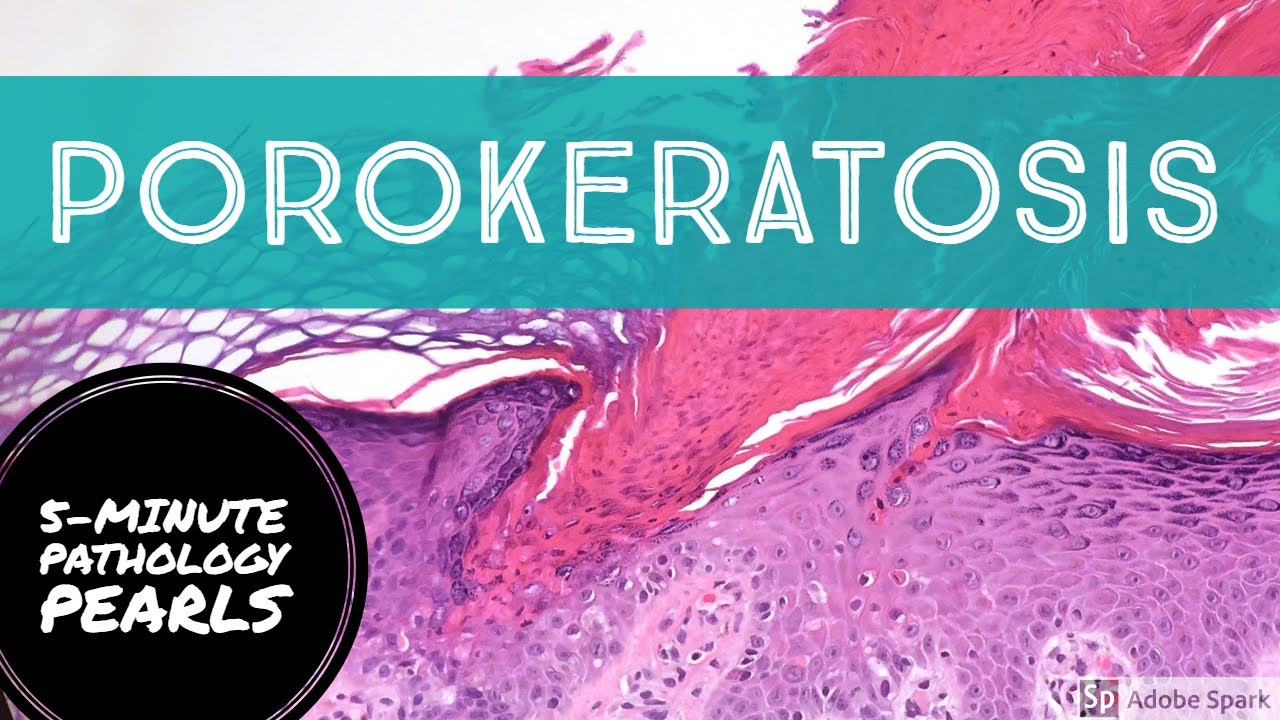 Porokeratosis: 5-Minute Pathology Pearls