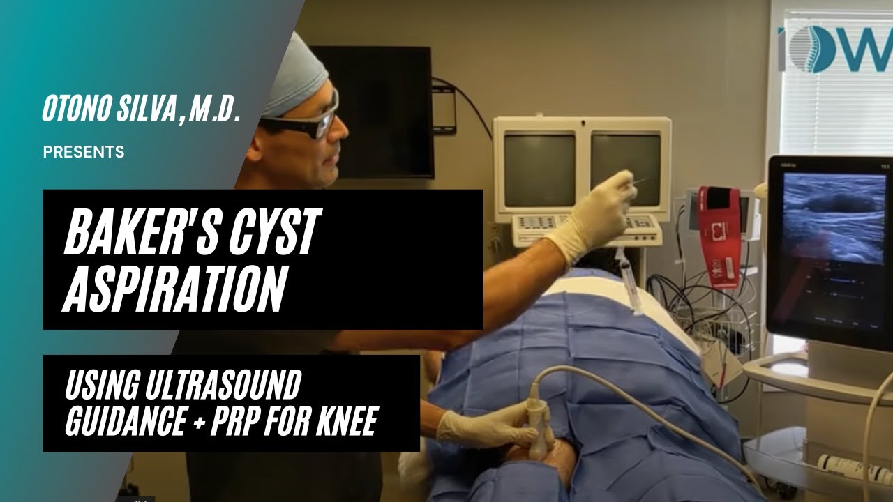 Baker's Cyst Aspiration + PRP