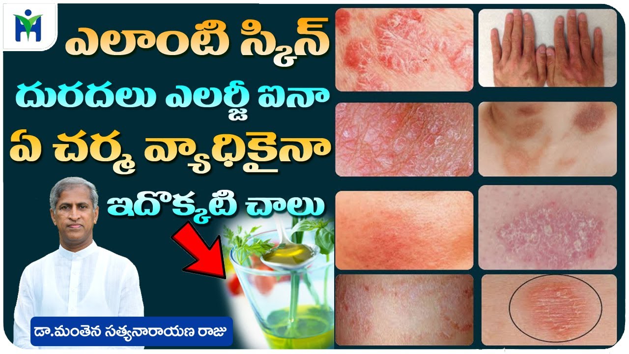 Skin Diseases Home Remedies in Telugu | Skin Allergy Oil | Charma | Dr Manthena Satyanarayana Raju