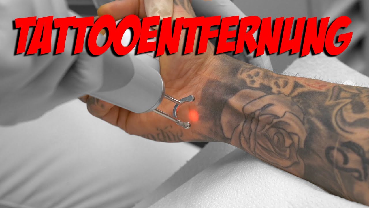 Tattooentfernung |  VALE TUDO