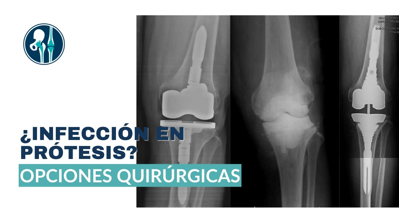 Tratamiento de Infección en Prótesis de Rodilla: Tipos y Opciones Quirúrgicas