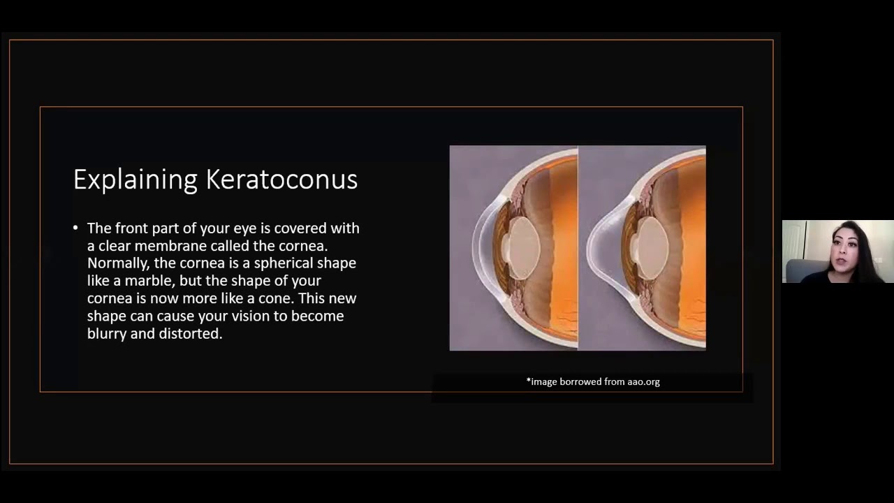 Management of the Keratoconus Patient