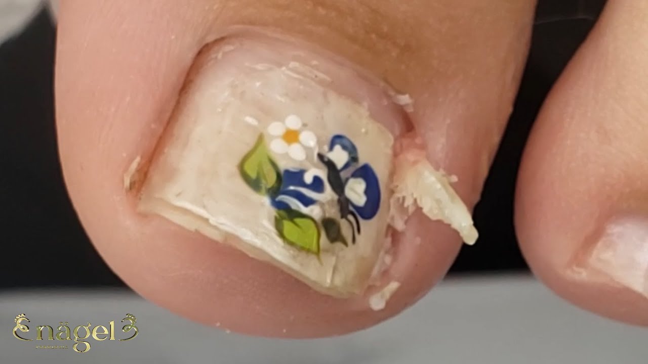 😱O TERROR DOS ADOLESCENTES (UNHA ENCRAVADA) #nails #ingrowntoenail