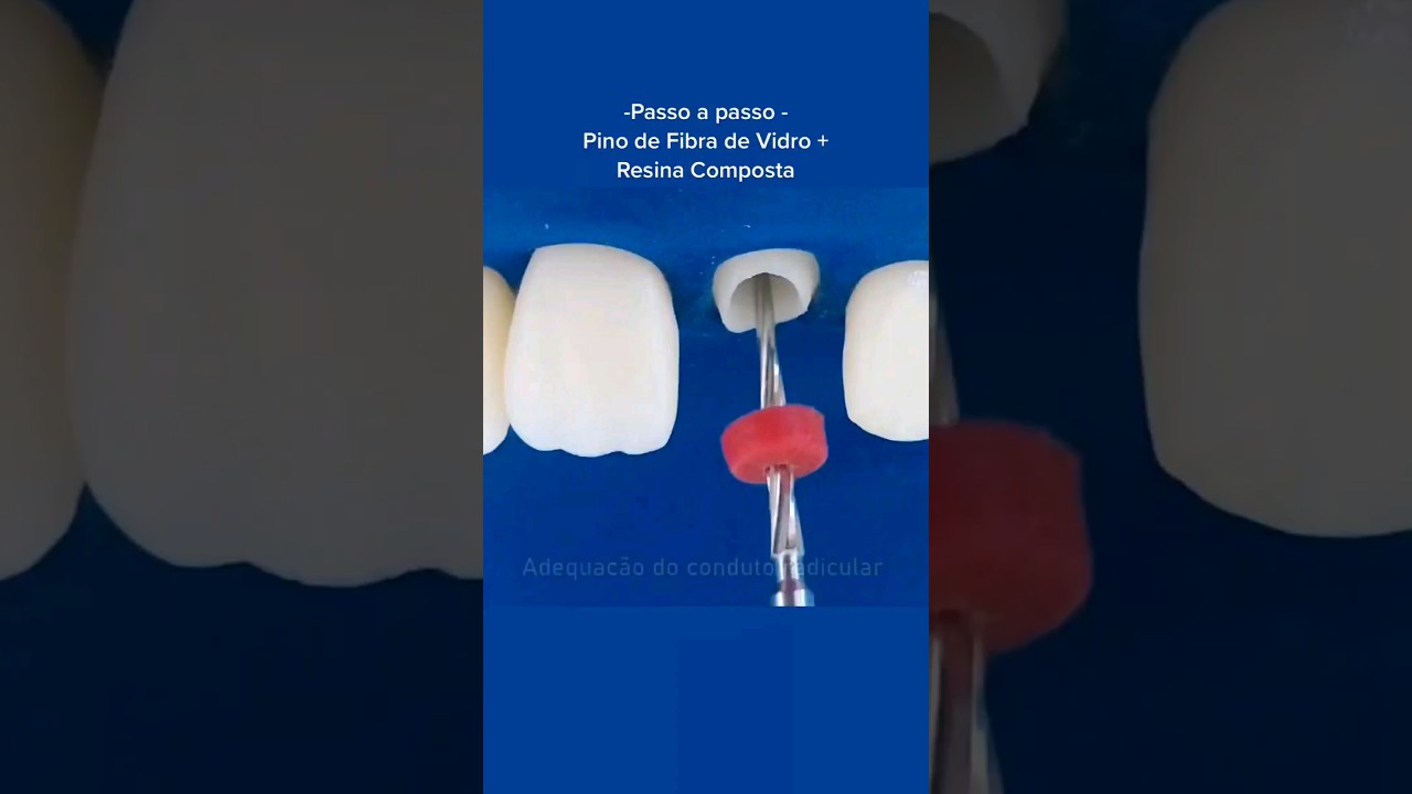 Passo a Passo - Pino Anat&ocirc;mico (Pino de Fibra de Vidro) #odonto #est&eacute;tica #dent&iacute;stica