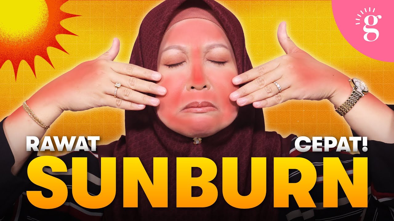 Kulit Muka Sunburn? Ini Langkah Demi Langkah Untuk Merawatnya 🌞