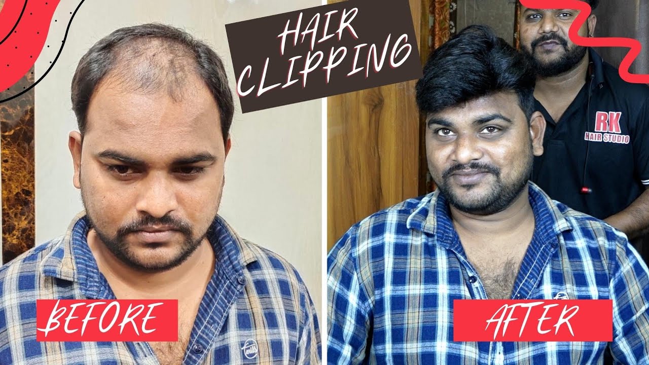 Clipping System In Hair Patch Methods | before and after Hair Makeover