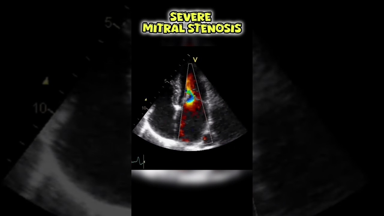 Severe Mitral Stenosis on Echocardiogram #mitralvalve #heart #echocardiography