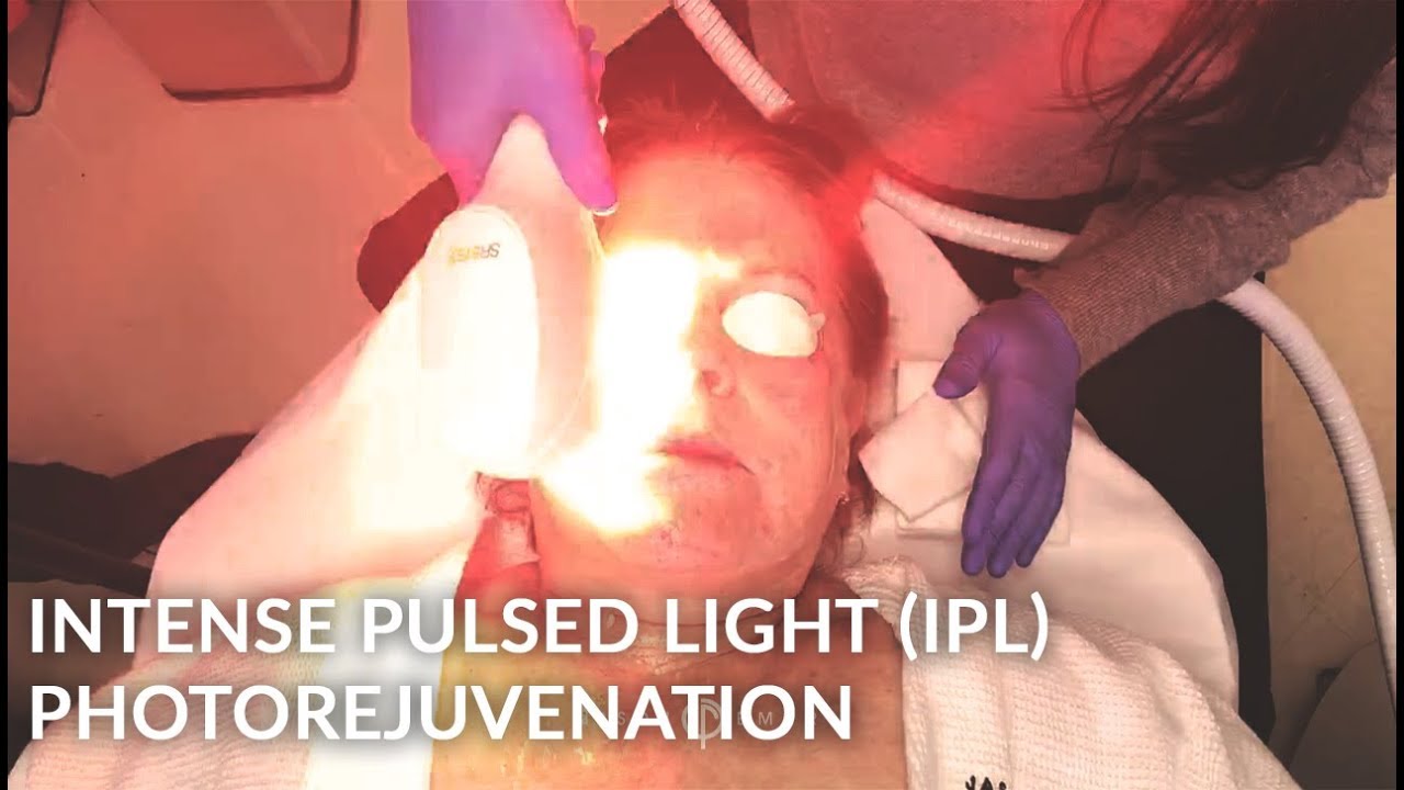 Venus Versa INTENSE PULSED LIGHT (IPL) | Photorejuvenation | Pigmented Skin | Dr. Jason Emer