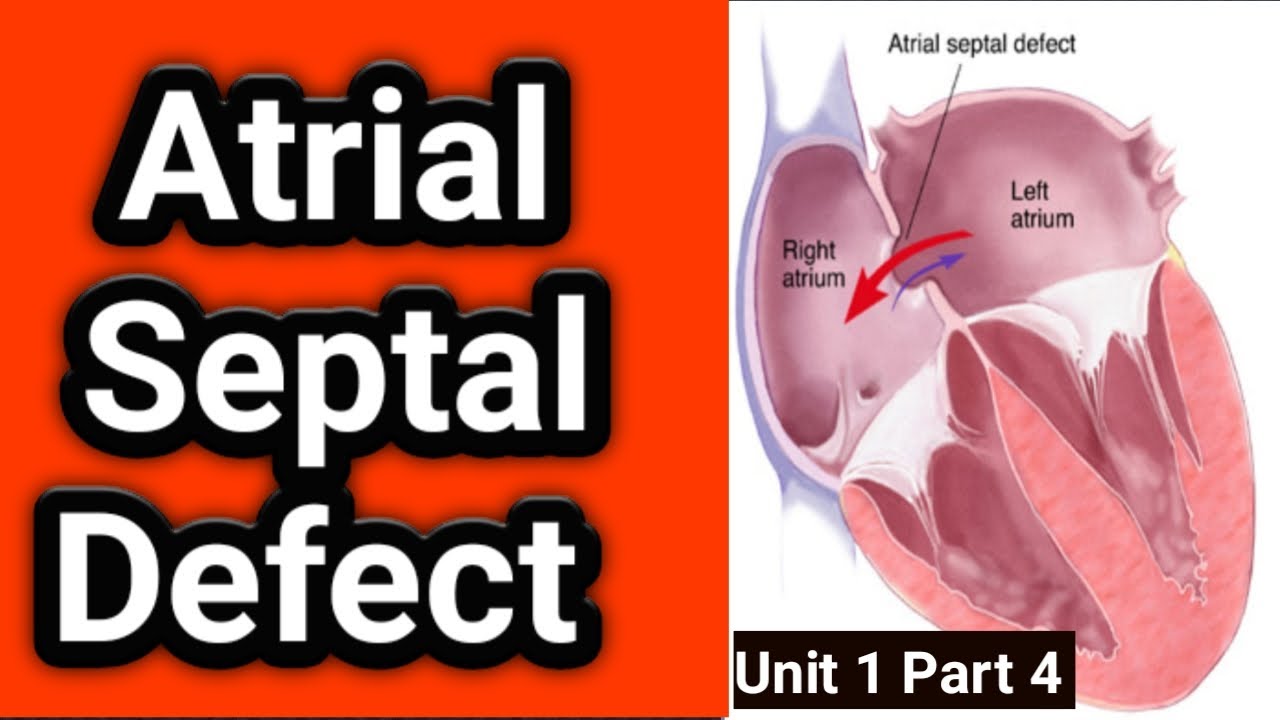 atrial septal defect (asd) | asd heart defect | hole in heart