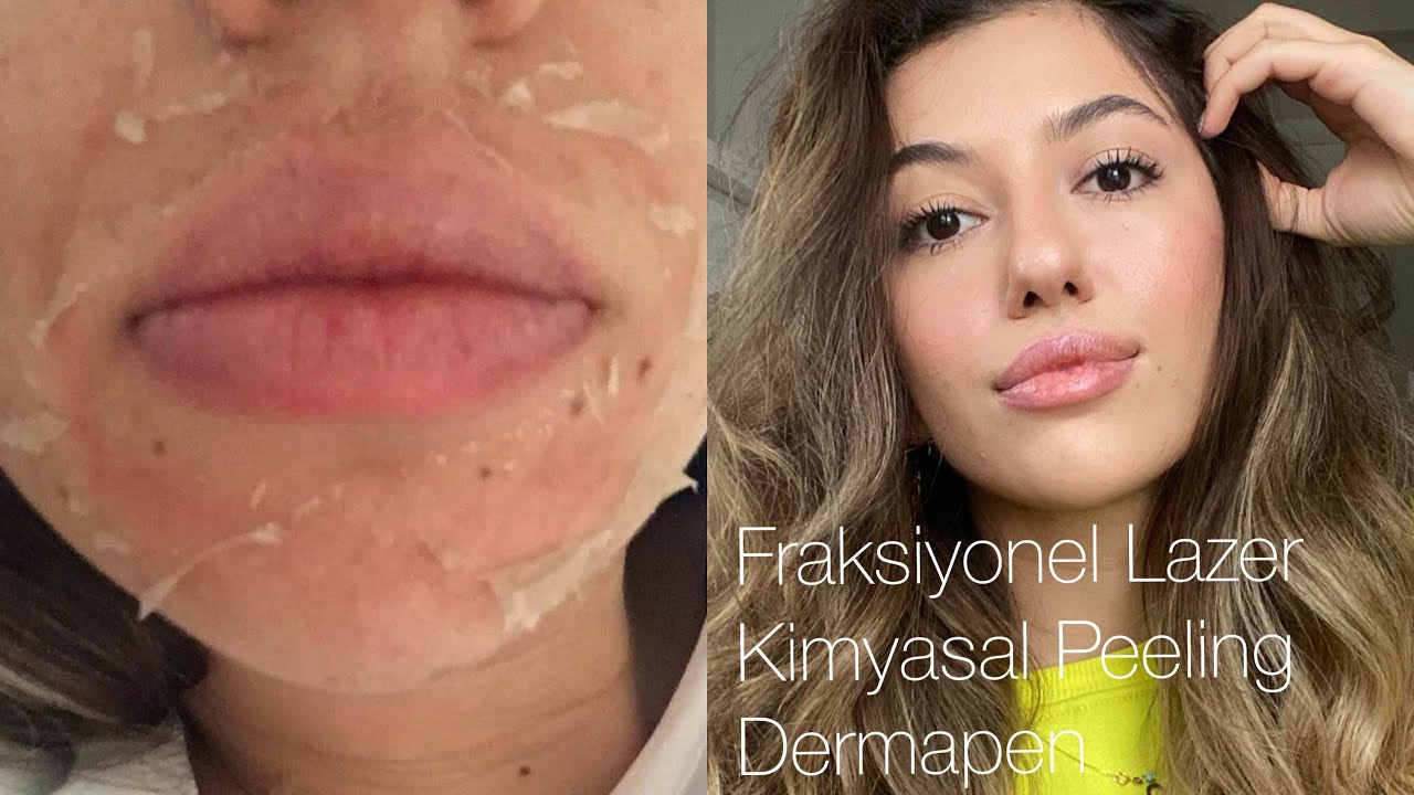 Cildime Neler Yaptırdım?Fraksiyonel Lazer-Kimyasal Peeling-Dermapen