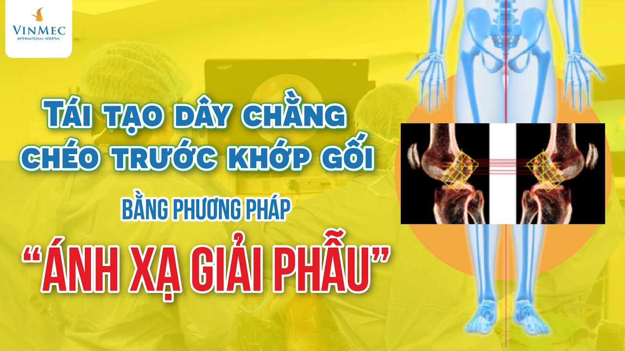 Tái tạo dây chằng chéo trước khớp gối bằng phương pháp “ánh xạ giải phẫu”