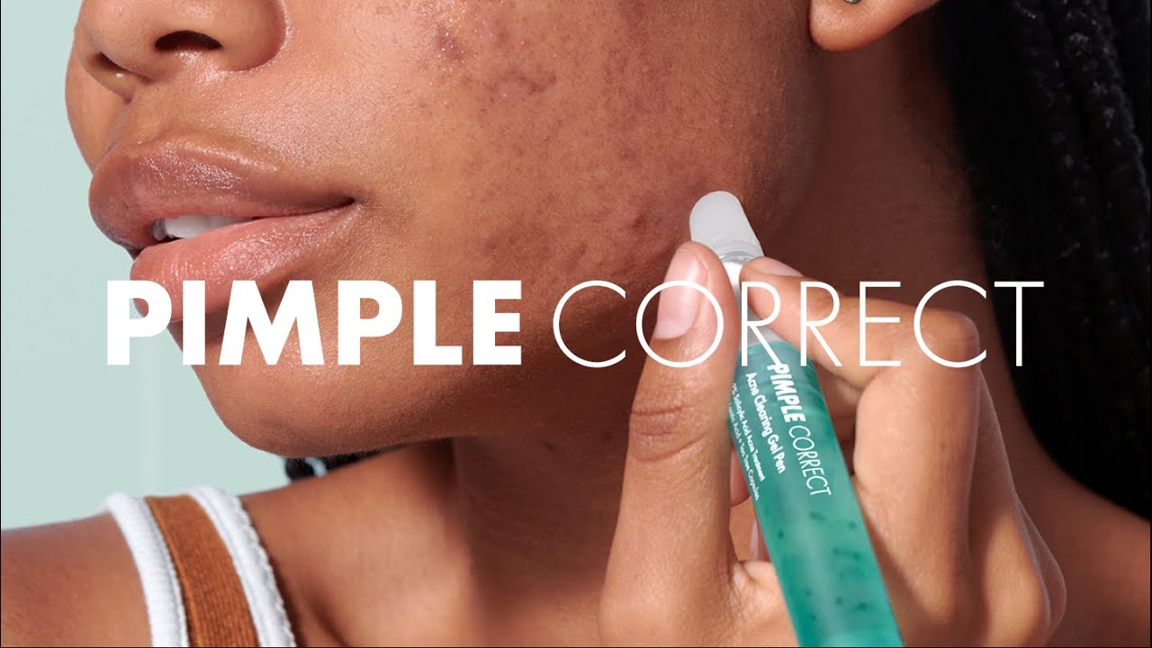Hero&rsquo;s NEWEST product: Pimple Correct ✨