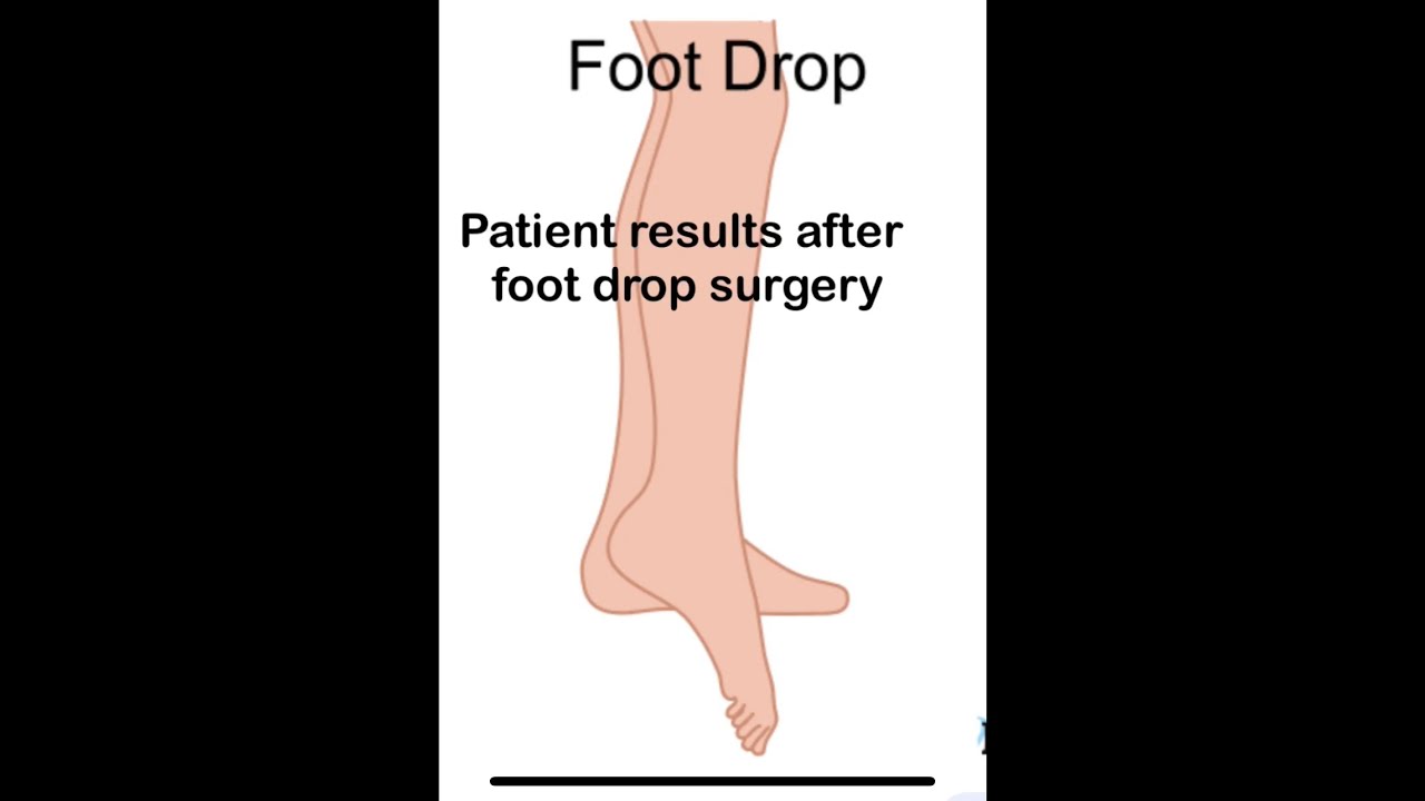 Foot drop Treatment  and Patient reviews after surgery