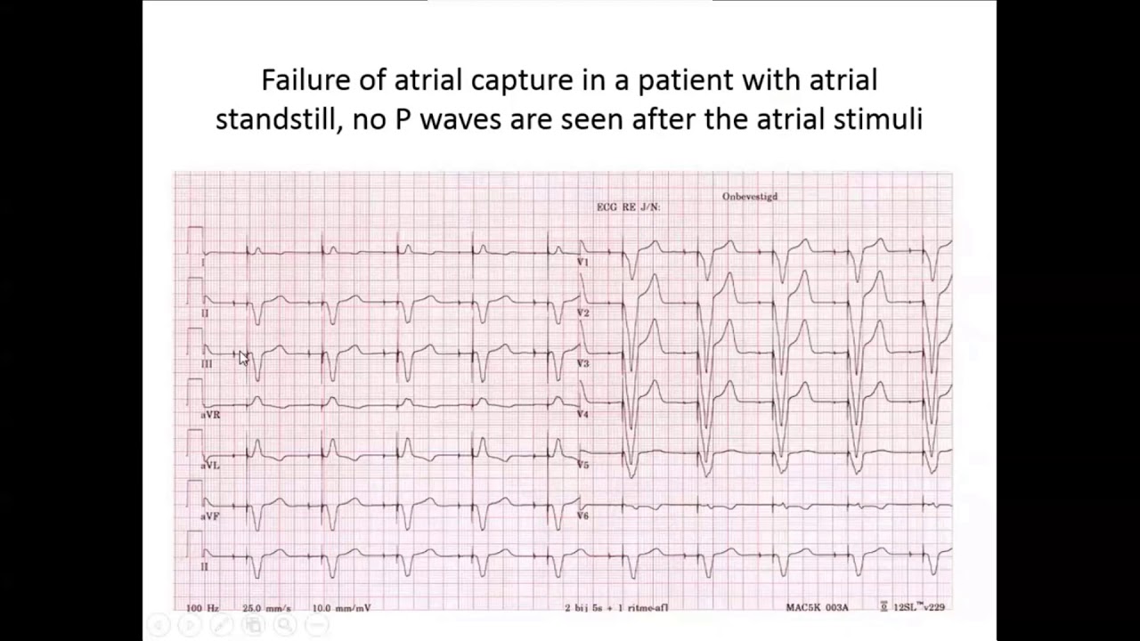Pacemaker Troubleshooting   Dr  Ahmed Nabil