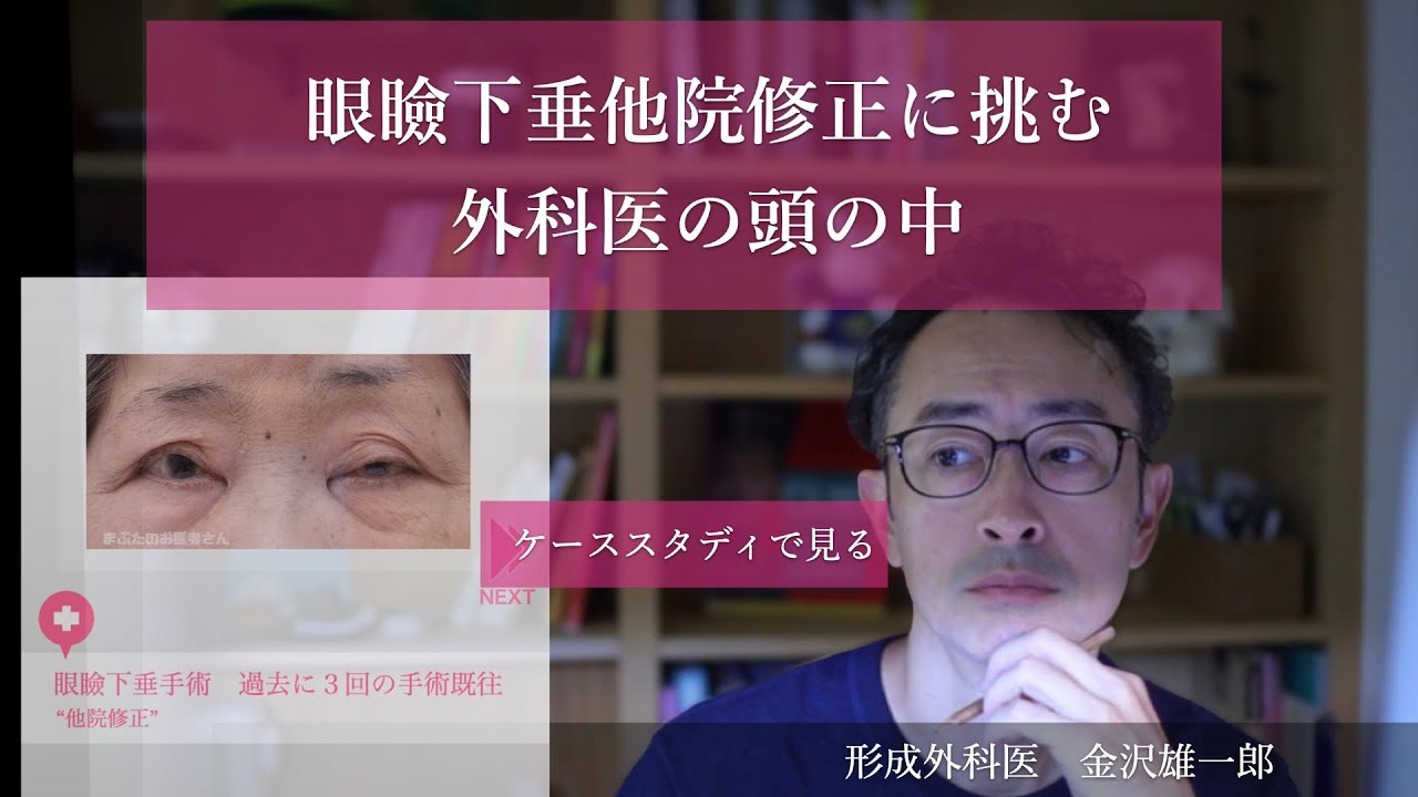 眼瞼下垂他院修正手術に挑む外科医の頭の中のほんの少しだけお話します