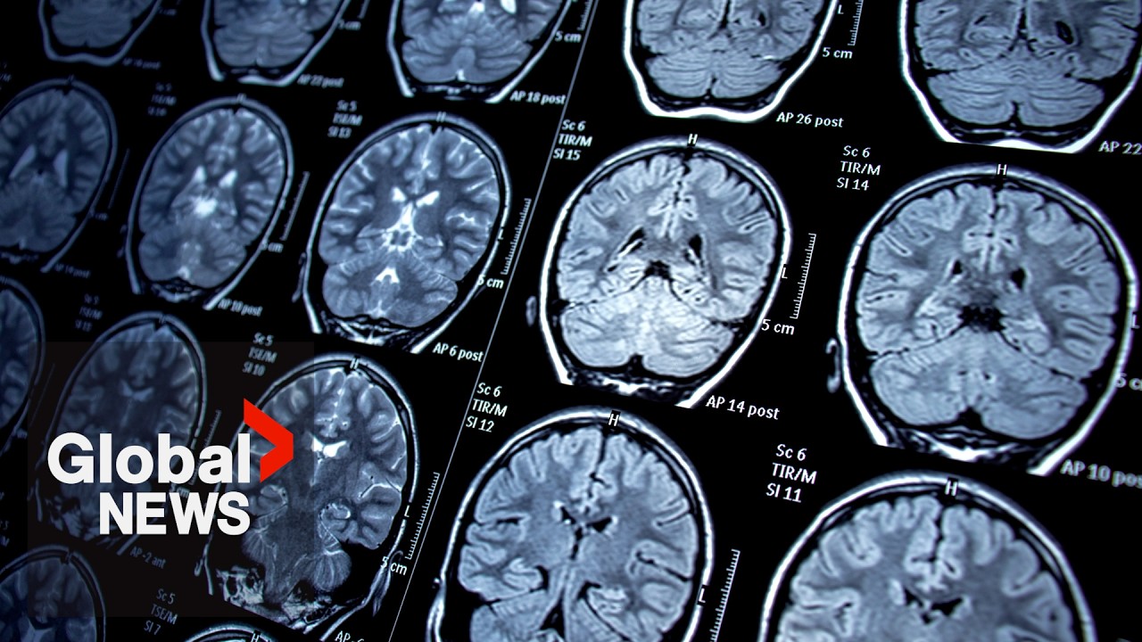 Public drug plans shouldn&rsquo;t cover Alzheimer&rsquo;s drug, CDA says