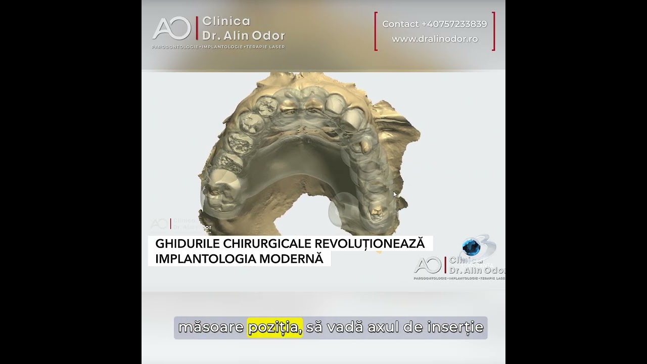 Ce sunt Ghidurile Chirurgicale? Află mai multe. Implantologia modernă