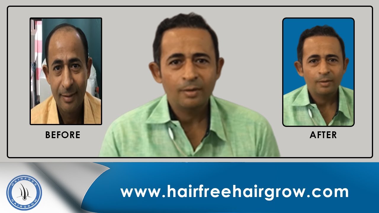 Hair Transplant Result & 2nd Session for Crown | HairFree HairGrow Ahmedabad | Dr. Richa Sanmukhani